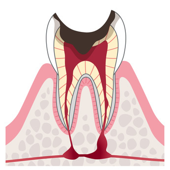 歯の根っこの治療は、この４ステップで進みます
